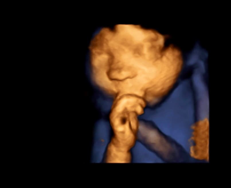 3D/4D ultrasound example